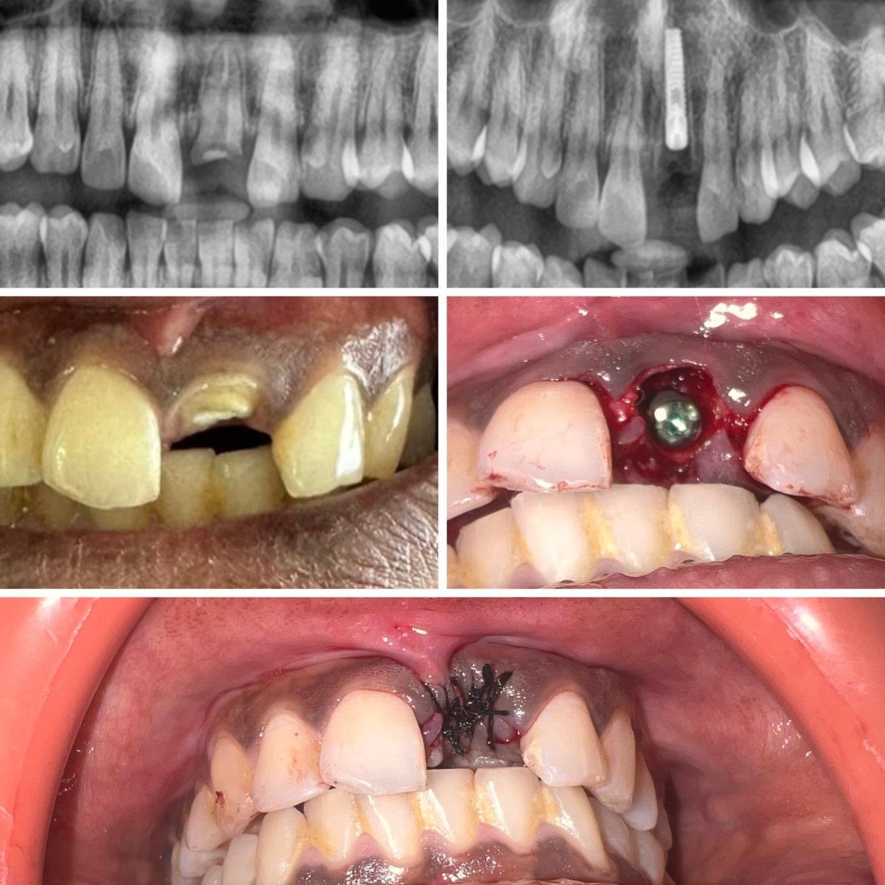 Single-Tooth Implant Placement