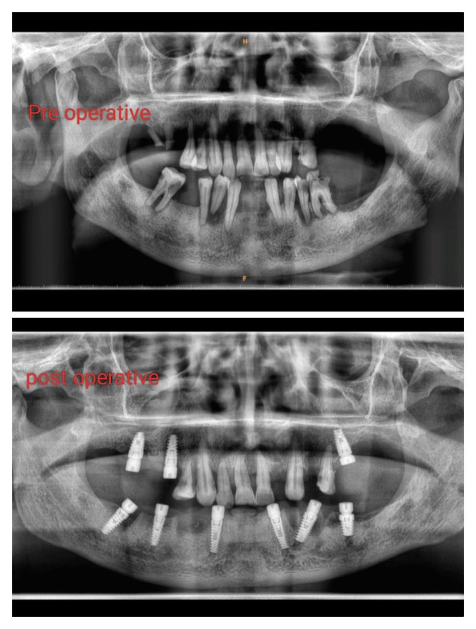 Full-Mouth Dental Implants