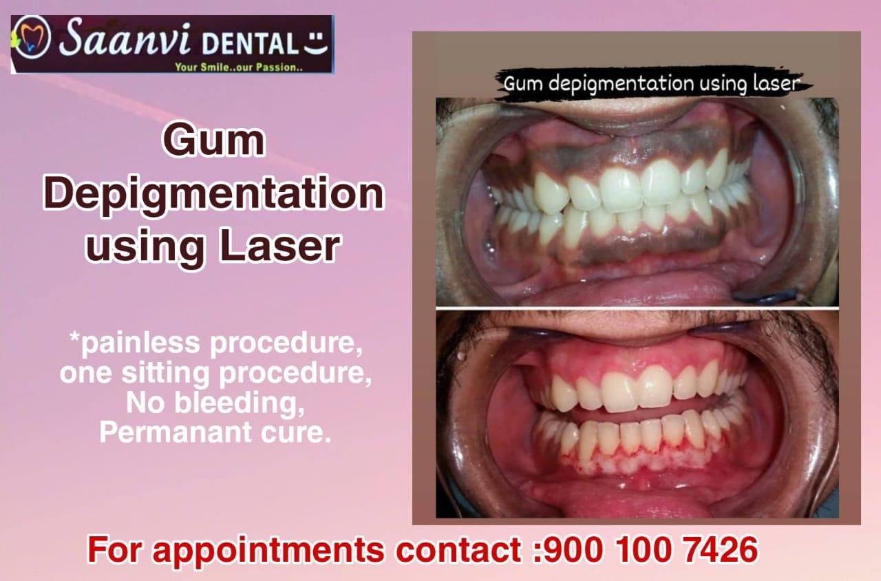 A gum depigmentation case treated with laser at Saanvi DENTAL. As with any procedure, comfort and healing time vary by patient — your dentist will set expectations specific to your case.