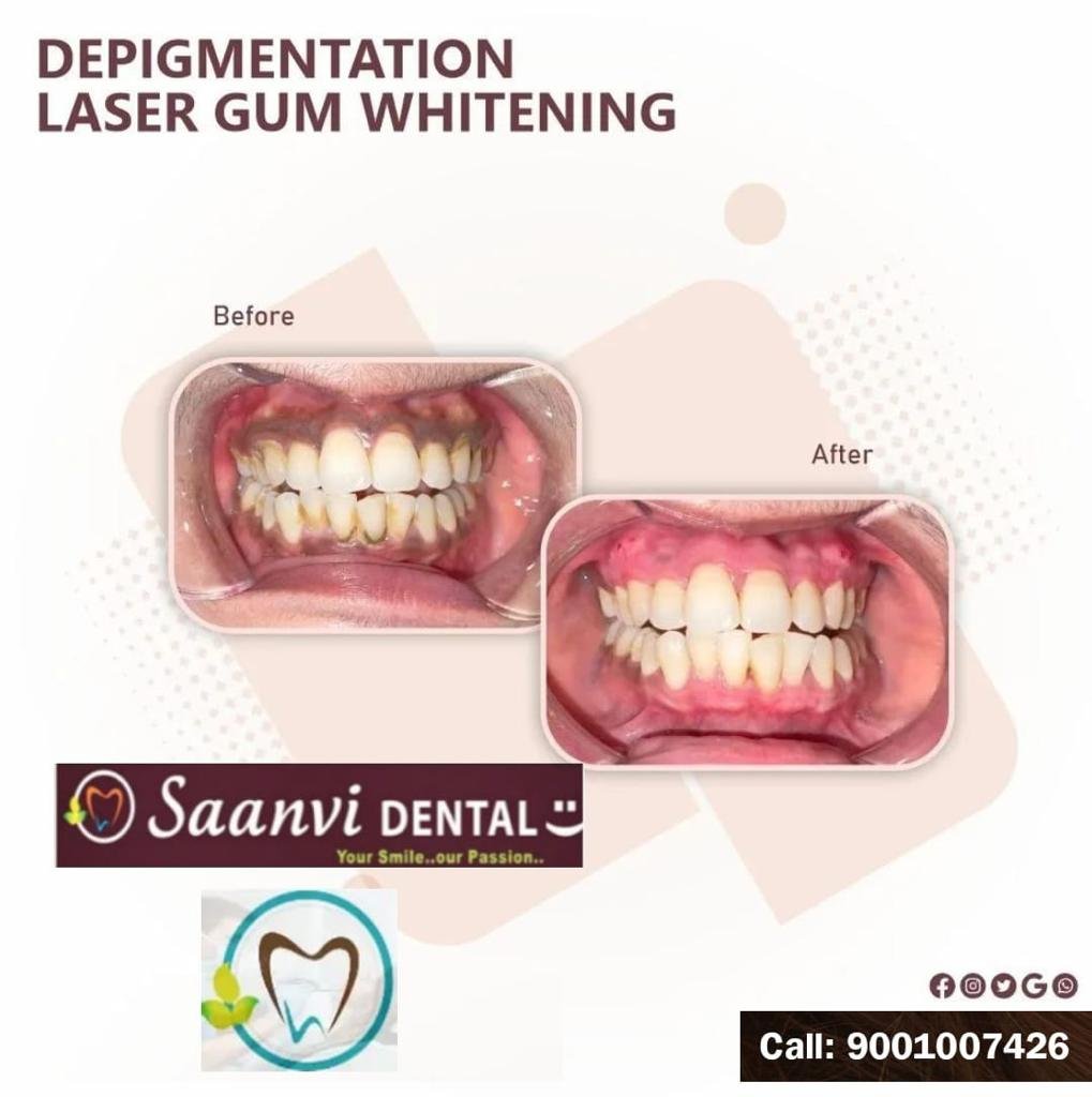 Laser Gum Depigmentation