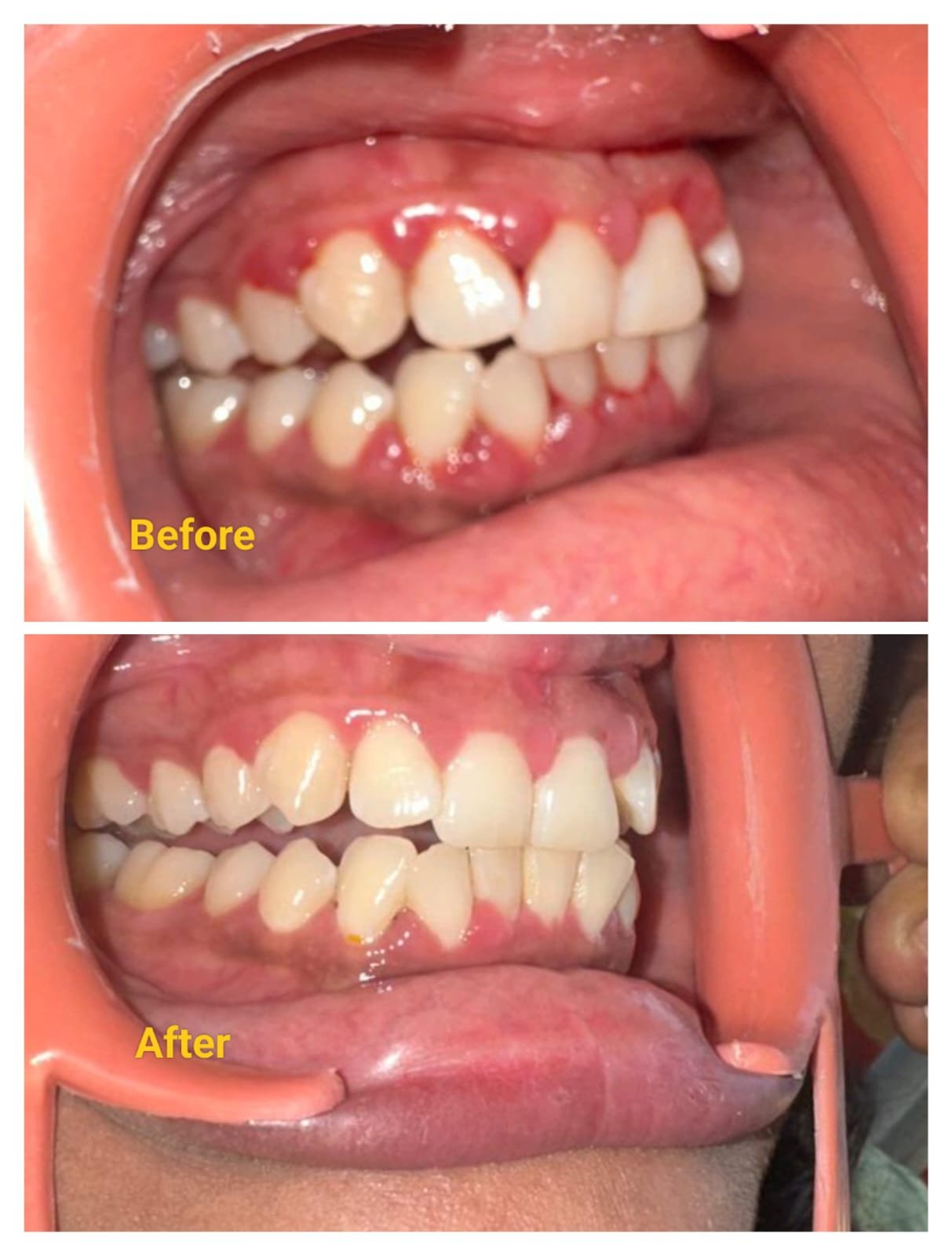 Gum Health Improvement