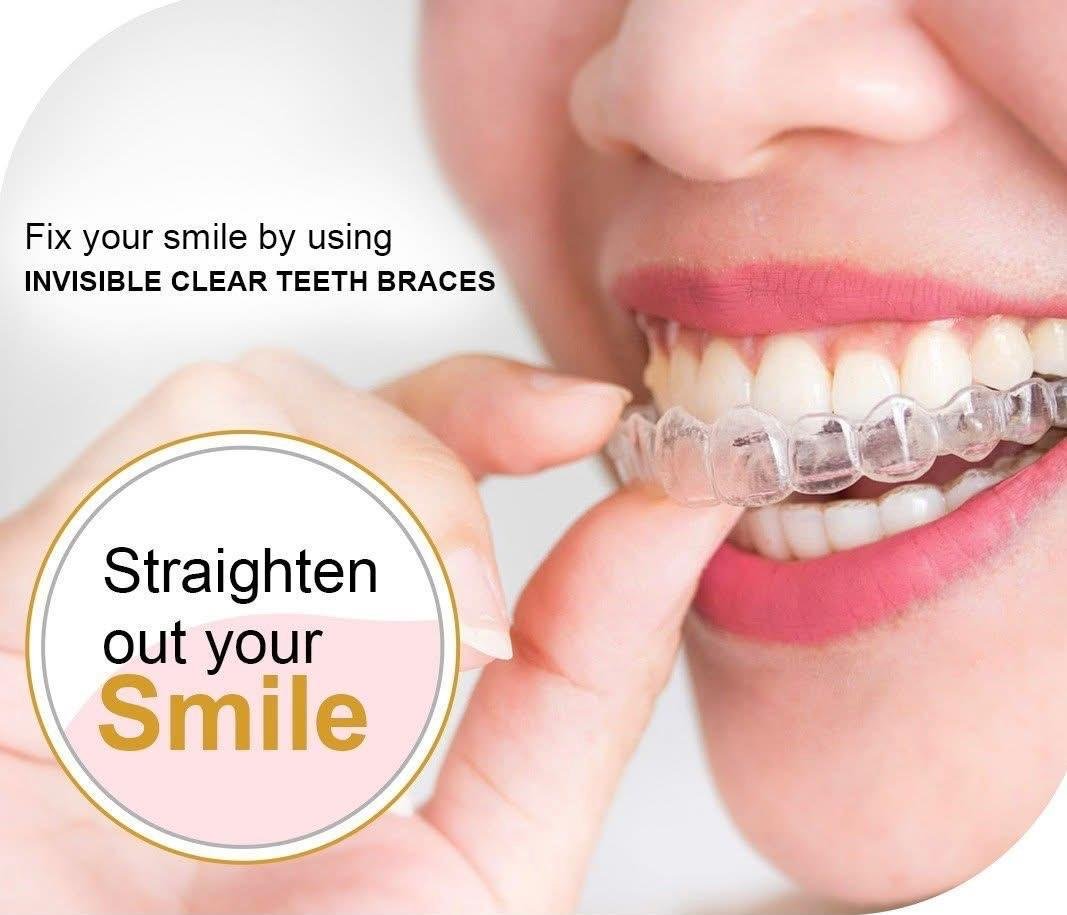 A clear aligner tray, worn to gradually shift teeth into better alignment without fixed brackets or wires.