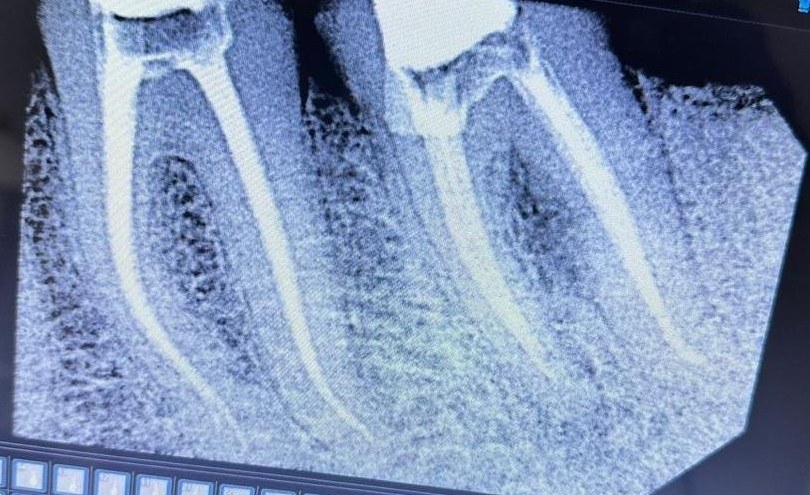 Root Canal Treatment