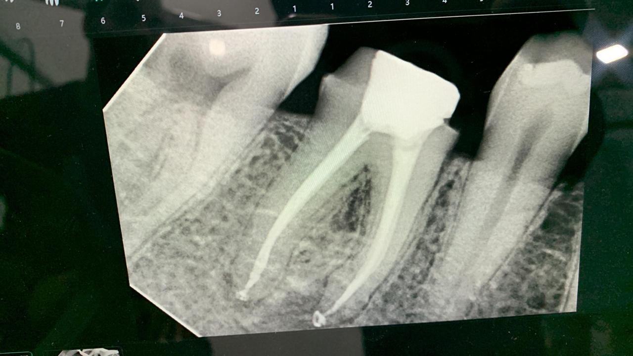 A dental X-ray showing a completed root canal — the cleaned canal filled and sealed, with a crown-ready tooth structure remaining.