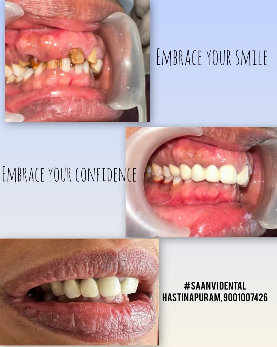 Smile Makeover — Crown Restoration
