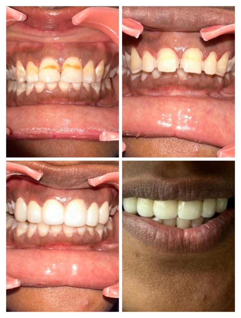 Porcelain veneers smile rehabilitation clinical result by Dr. Hemanth at Saanvi DENTAL, Hastinapuram