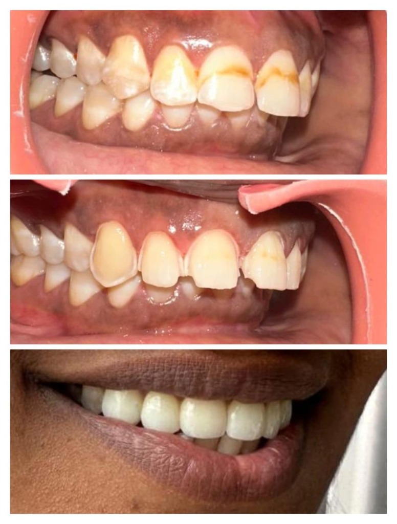 Case Study: Lateral profile transformation with porcelain veneers by Dr. Hemanth at Saanvi Dental, Hastinapuram